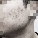 인천여드름전문 한의원 잘하는곳 찾는 기준이란