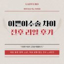 명비뇨기과의원 | 이쁜이수술 차이 전후 리얼후기