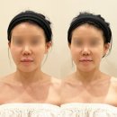 위뷰티 | 연예인 경락 발로하는 승모근 마사지 위뷰티 재방문 후기