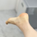 걸포솔약국 | 장기동 발각질 로션 발라도 건조한 발 레푸스 김포걸포점에서 해결했어요!
