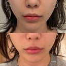 아비 | 영등포 여드름 피부과 아비클리어 후기 내돈내산 여드름 치료 기록