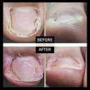 홀드핀칭 이미지