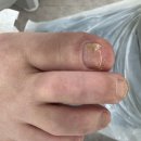 레푸스앤두두뷰티 | 의정부문제성발톱관리 레푸스 앤 두두뷰티, 두꺼워진 발톱 스케일링 관리 후기