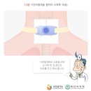 기관절개술의 합병증 이미지
