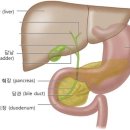 크루켄벨그 종양(Krukenberg`s tumor) 이미지