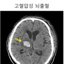 겨울철, 운동부족·혈압상승 등으로 뇌동맥류·뇌출혈 환자 늘어 이미지