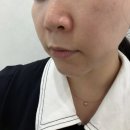 200 | 논현 울트라콜200 후기 논현 피부과 울트라콜 효과