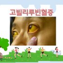 경고비 | 고빌리루빈혈증 원인과 증상 황달이 보내는 경고