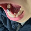 뷰티스마일치과의원 | 김해 율하 스마일라인치과 아기 교정 상담 후기 돌출입 앞니 튀어나옴 치아 공간 없음