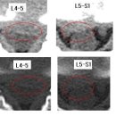 나나도님의 허리디스크 L4-5, L5-S1 CT사진 판독입니다. 이미지