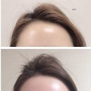 영하다뷰티 | 동대문헤어라인 금손 영하다뷰티 후기 : 이마 성형 아님