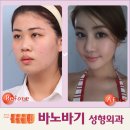 역삼바노바기성형외과 네이버블로그