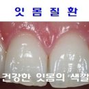 다시 쓴 (나만의 잇몸 치유법) 이미지