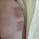 황혜영소아과의원 | 정자동 소아과 추천 - 경피용 BCG 예방접종 및 가격