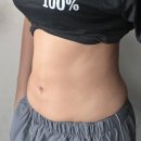 예스병원 | 세이예스의원 - 대용량 뱃살 복부지방흡입 2달차 후기 전후사진 기록🧾