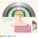 뇌정위적방사선수술(연간1회한,급여)보장 특별약관 이미지
