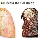 폐질환 진폐증 원인 증상 치료 초미세먼지 폐암 유발 이미지