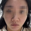 O.K한잔할래 | 신사 민트실리프팅 솔직 후기! 2주차 붓기, 통증, 30대중반 리프팅 효과까지