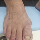 리오풋케어 | 동대문 신설동 발톱무좀 문제성 발관리 전문샵 리오풋케어