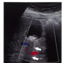 담석 (Gallstone)과 담낭슬러지 (Gallbladder sludge) 이미지