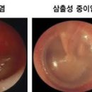 만성 중이염 삼출성중이염 방법 이미지