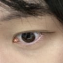 H1143 | 눈물언덕 지방 결막낭 제거 수술 후기 (눈앞머리 노란색)