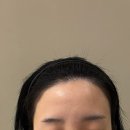 [강남/선릉] 모센트스튜디오 : “또렷하고 봉긋한 이마로 만들어주세요“ , 20대초반 여성 헤어라인교정...