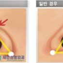 세민성형외과의원 네이버블로그