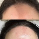 이미지헤어라인 | 광주 왁싱샵 슈가링 릴리브 결혼 전 필수관리 헤어라인 뒷목왁싱 후기