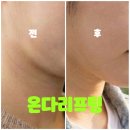 레나의원 | 홍대포레나의원 온다리프팅 6만줄 3차 후기｜효과 · 유지기간