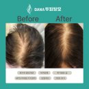 항우의료기기 | 부산 여자 탈모 원인과 빠른 개선 7회차만에 나아진 후기