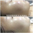 덕피부 여드름자국 트러블자국 노화탄력 모두 고민이라면 브이오티 해초필링하세요~! 덕천피부관리실