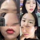 서광석 | [압구정로데오피부과]내돈내산 피부갱생 후기/좁쌀여드름,기미,색소 완전타파 “닥터이레이저피부과”