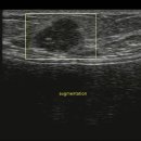 augmentation cancer 유방확대술 유방암 이미지