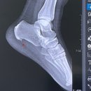 대구병원 | 대구 족저근막염 병원 후기 발바닥 가운데 통증