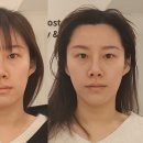 후케어 | 수원 퍼스널 윤곽관리 :: 리프팅 시술 후 비대칭 교정 케어 후기