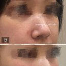 논현<리오셀 의원>콜라겐 주사 내돈내산 후기