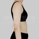 레아트성형외과의원 | 팔 지방흡입의 디테일: ‘매끄러운 라인’을 결정짓는 3대 주의구간 [닥터's 노트 by.최평림 원장]