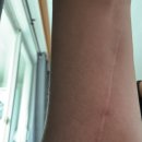 상무병원 | 26.02.22 광주상무병원 수술13개월차 후기(일기)