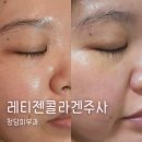 청담피부과 스킨부스터 레티젠콜라겐주사로 눈밑 이마꺼짐 해결한 후기
