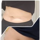 복부지방파괴 강남 튠라이너 후기 바디 톤도 이뻐짐
