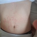 중학생아이 몸에 두드레기가 났는데요 이미지