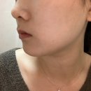 의정부연세이예쁜치과교정과치과의원 | 내돈내산) 의정부 교정치과 연세 이예쁜치과 클리피씨 교정 시작 일기