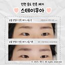 인천잔흔제거 스테이무아 후기, 일상 지장 없고 확실히 달라졌어요!