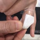 주  정형외과 | 손가락 내연골종 Enchondroma 천호역 정형외과 수술 후기 2편