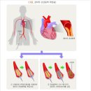 관상동맥 혈관조영술(Coronary Artery Angiography:CAG)이란 이미지