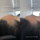 모드니헤어라인