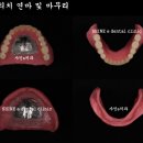 샤인치과기공소 네이버블로그