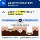 발목이 아파요, 연골 주사 vs 수술 선택을 앞두고 있다면 이미지