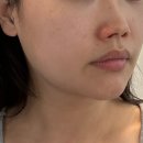 울산 달동 30대 윤곽 올티모 리프팅 유드림에스테틱 솔직후기